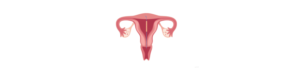 GyneFIX